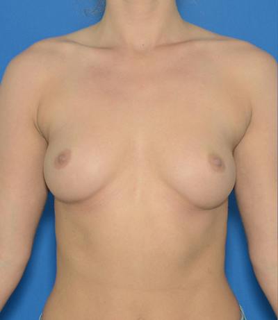 Breast Augmentation Before & After Gallery - Patient 369007 - Image 1
