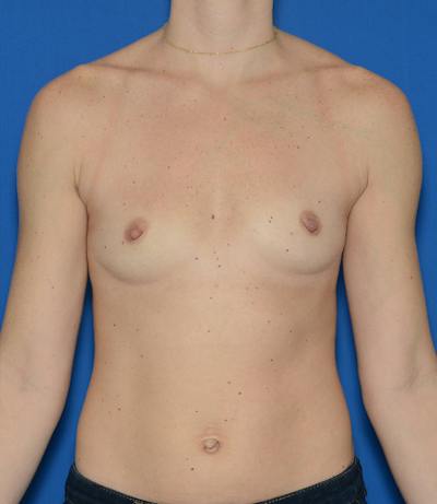 Breast Augmentation Before & After Gallery - Patient 582251 - Image 1