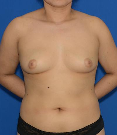 Breast Augmentation Before & After Gallery - Patient 643201 - Image 1
