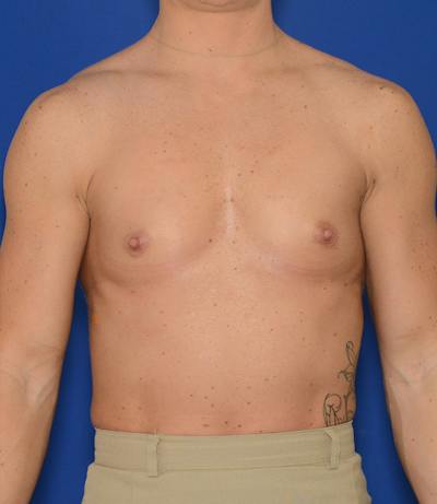 Breast Augmentation Before & After Gallery - Patient 765669 - Image 1