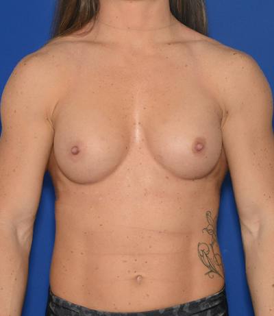 Breast Augmentation Before & After Gallery - Patient 765669 - Image 2