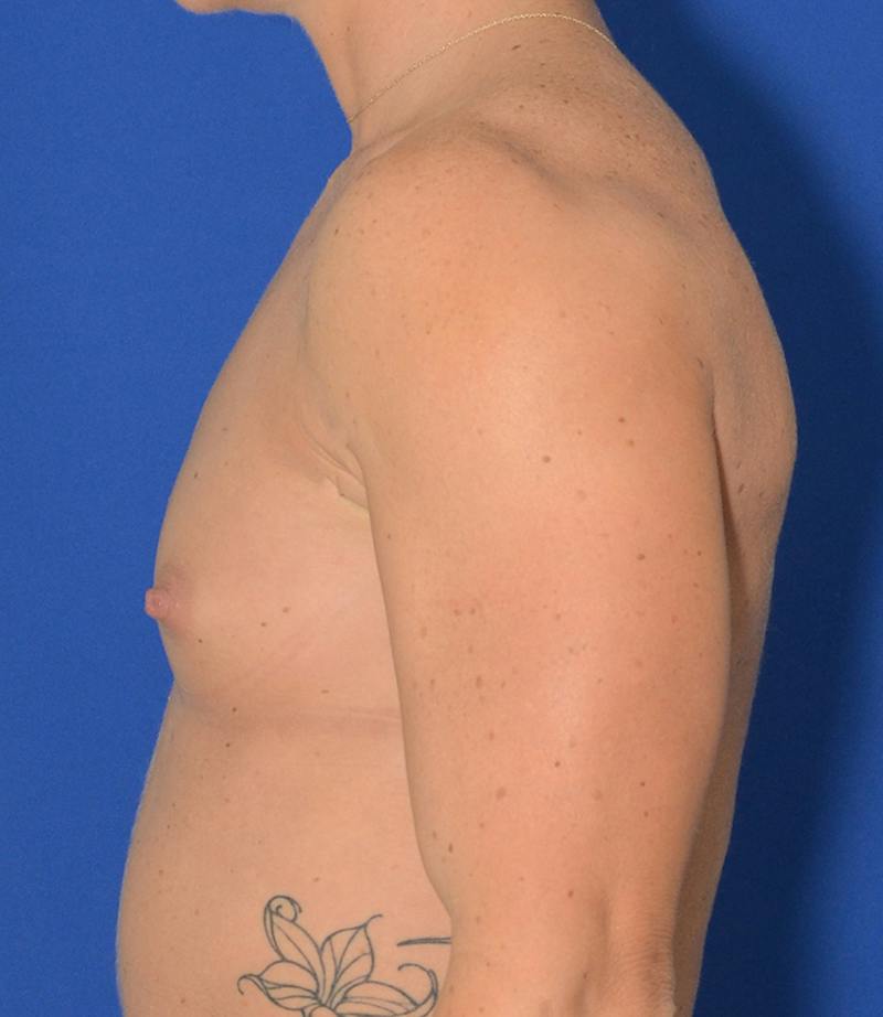 Breast Augmentation Before & After Gallery - Patient 765669 - Image 3