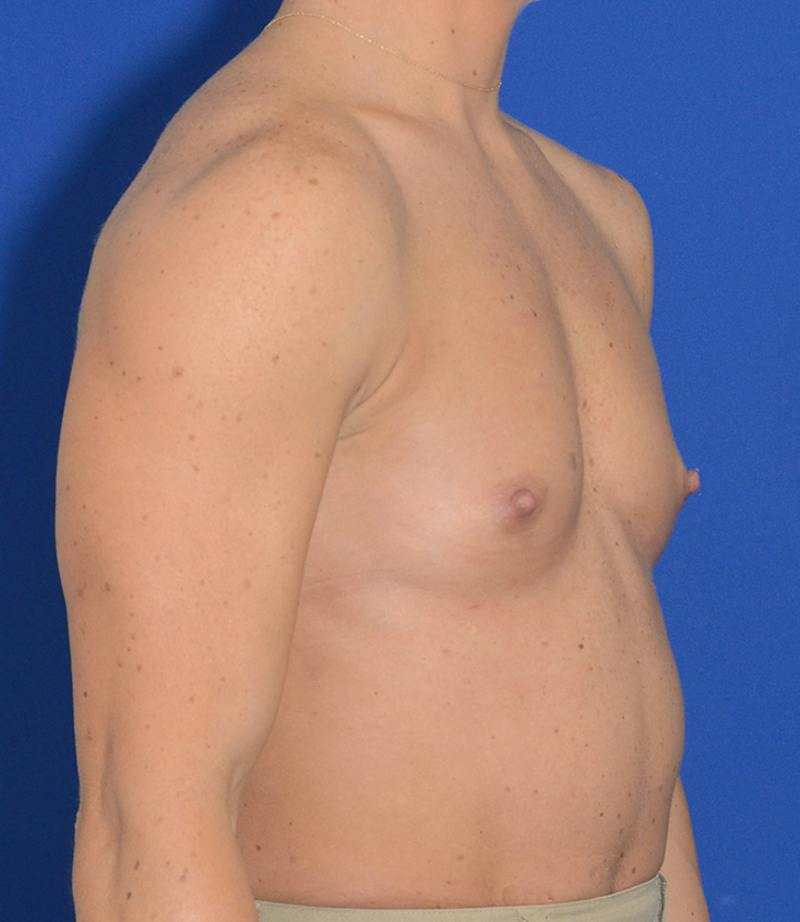 Breast Augmentation Before & After Gallery - Patient 765669 - Image 9