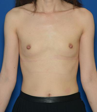 Breast Augmentation Before & After Gallery - Patient 347519 - Image 1