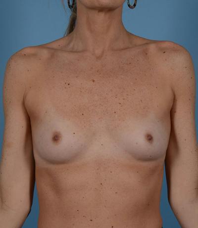 Breast Augmentation Before & After Gallery - Patient 332316 - Image 1