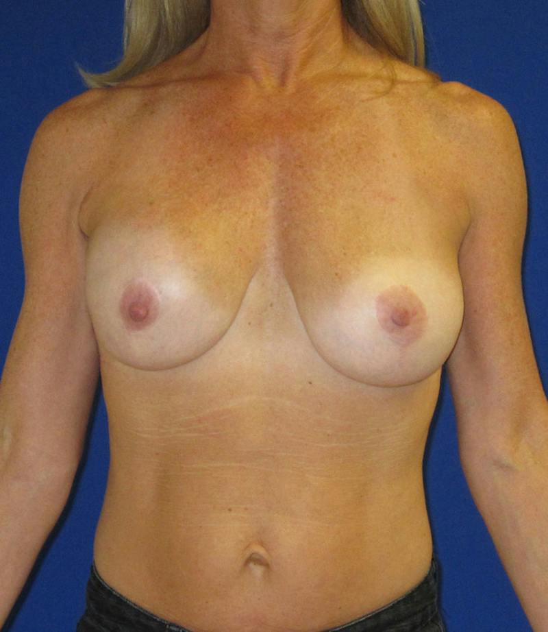 Breast Augmentation And Lift Before & After Gallery - Patient 996384 - Image 1