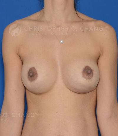 Breast Augmentation And Lift Before & After Gallery - Patient 246899 - Image 2
