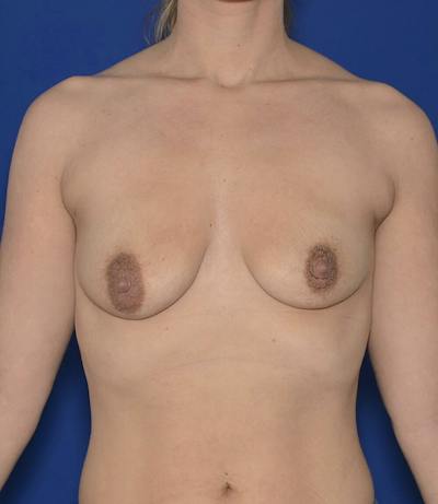 Breast Augmentation And Lift Before & After Gallery - Patient 124858 - Image 1