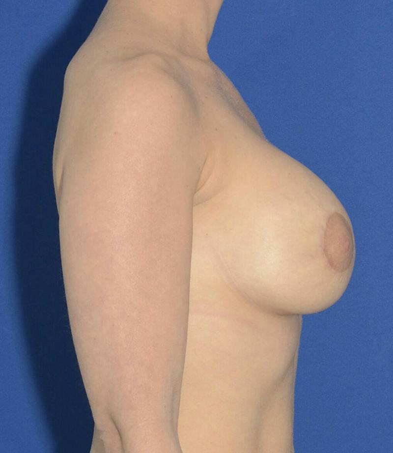 Breast Augmentation And Lift Before & After Gallery - Patient 124858 - Image 6