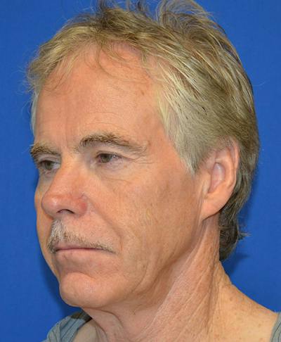 Male Plastic Surgery Before & After Gallery - Patient 135775 - Image 1