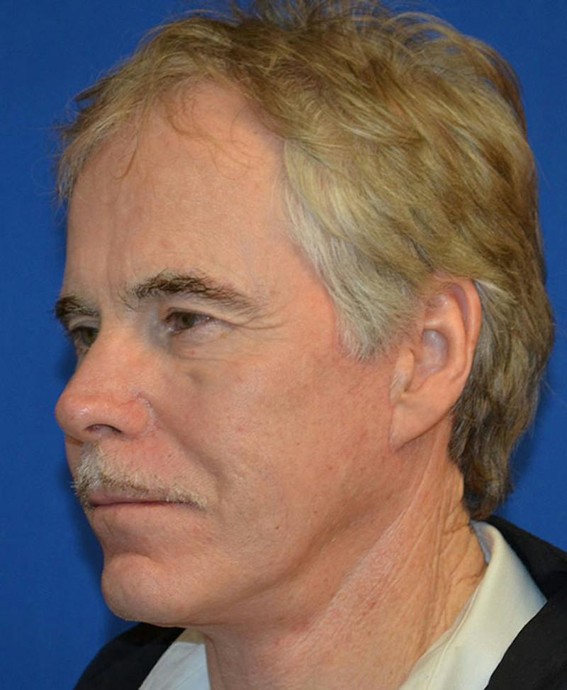 Male Plastic Surgery Before & After Gallery - Patient 135775 - Image 2
