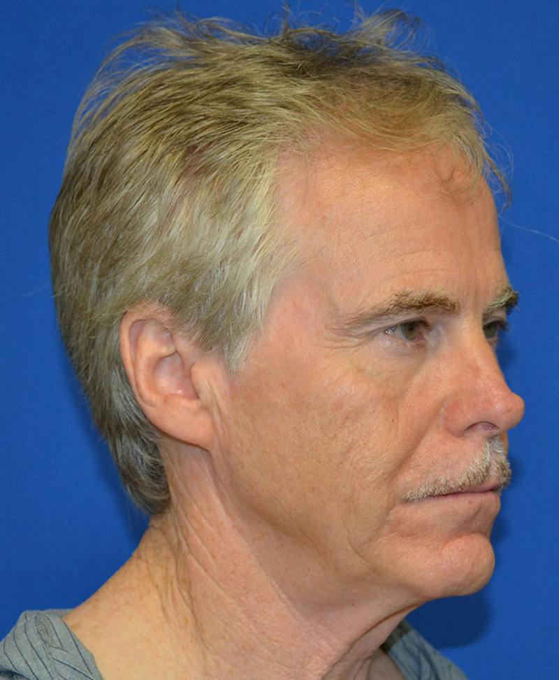 Male Plastic Surgery Before & After Gallery - Patient 135775 - Image 3