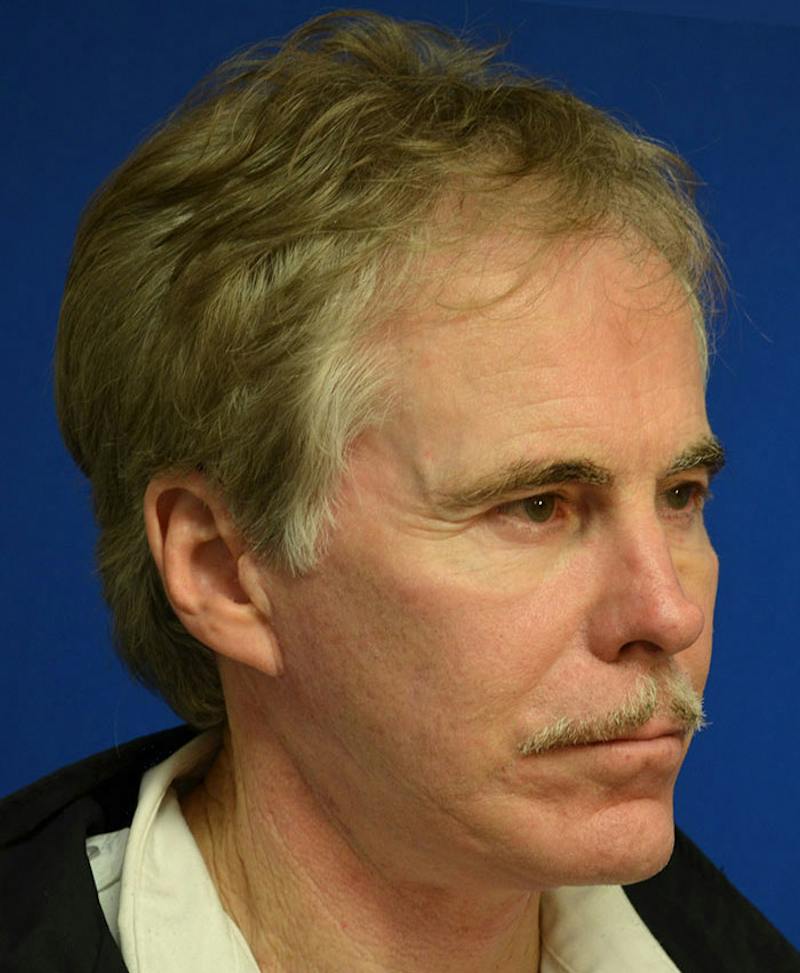Male Plastic Surgery Before & After Gallery - Patient 135775 - Image 4