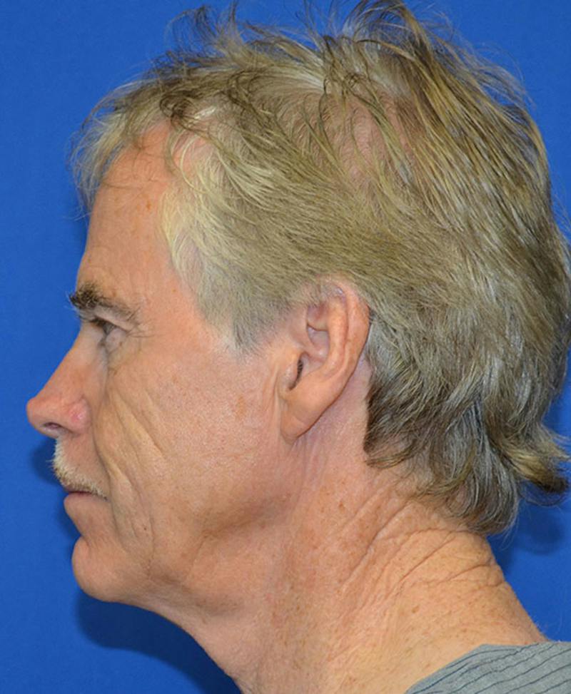 Male Plastic Surgery Before & After Gallery - Patient 135775 - Image 5