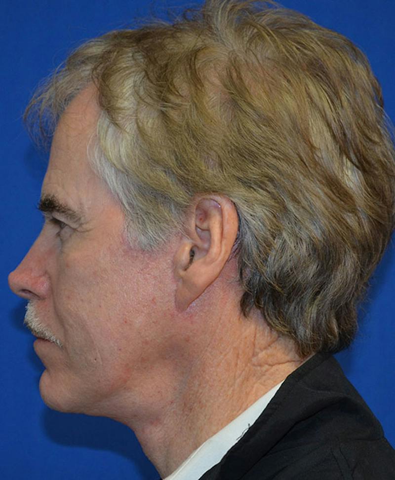 Male Plastic Surgery Before & After Gallery - Patient 135775 - Image 6