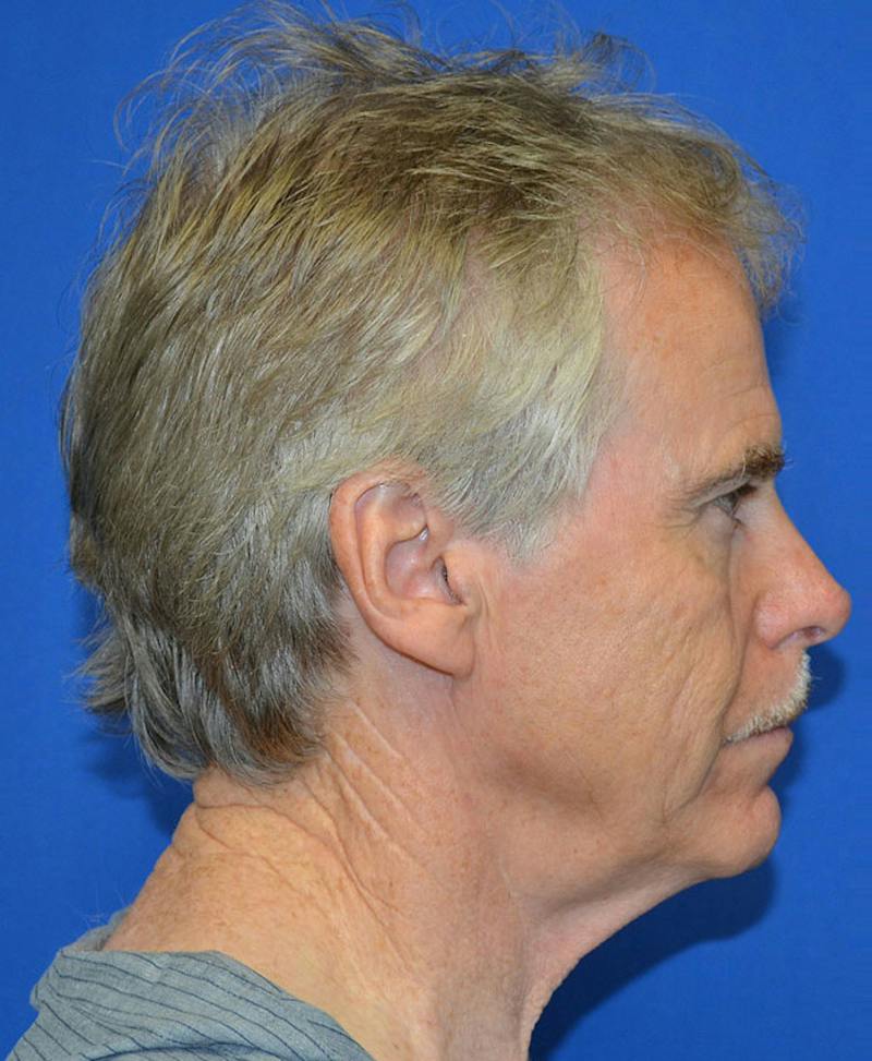 Male Plastic Surgery Before & After Gallery - Patient 135775 - Image 7