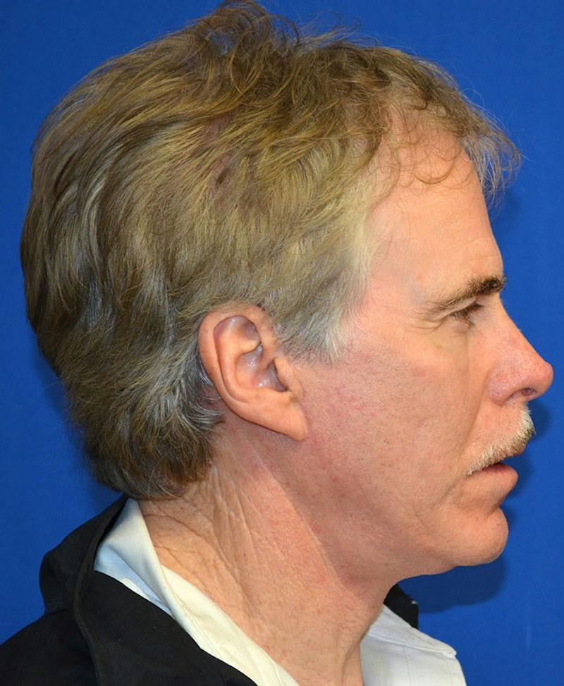 Male Plastic Surgery Before & After Gallery - Patient 135775 - Image 8