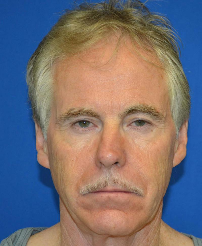 Male Plastic Surgery Before & After Gallery - Patient 135775 - Image 9