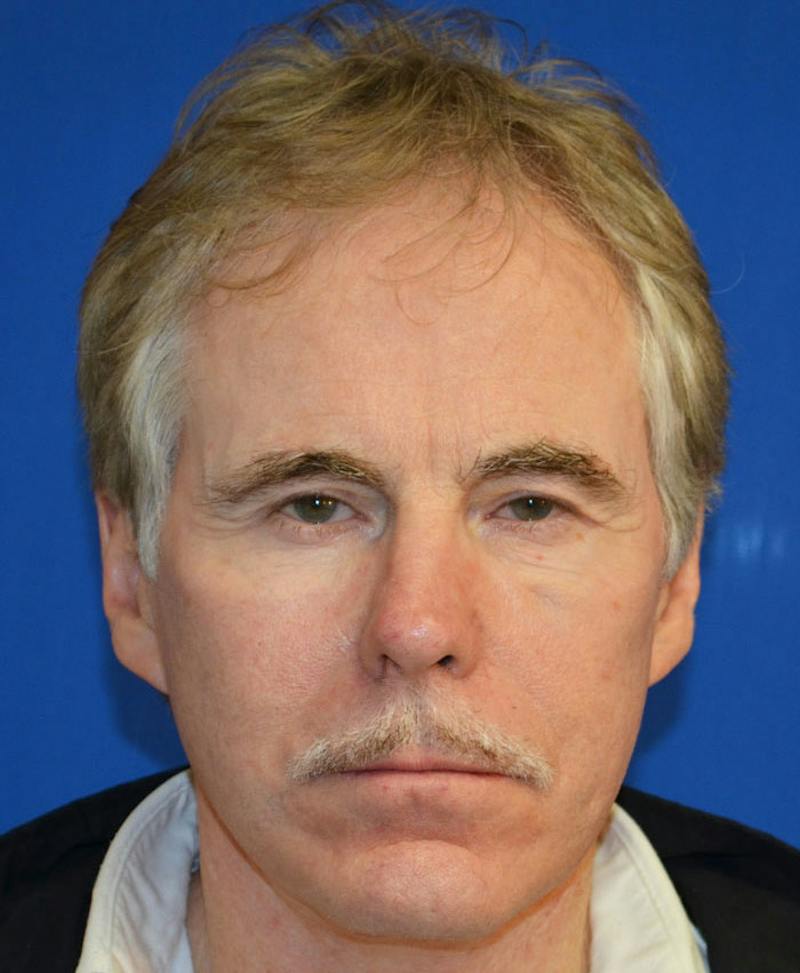 Male Plastic Surgery Before & After Gallery - Patient 135775 - Image 10