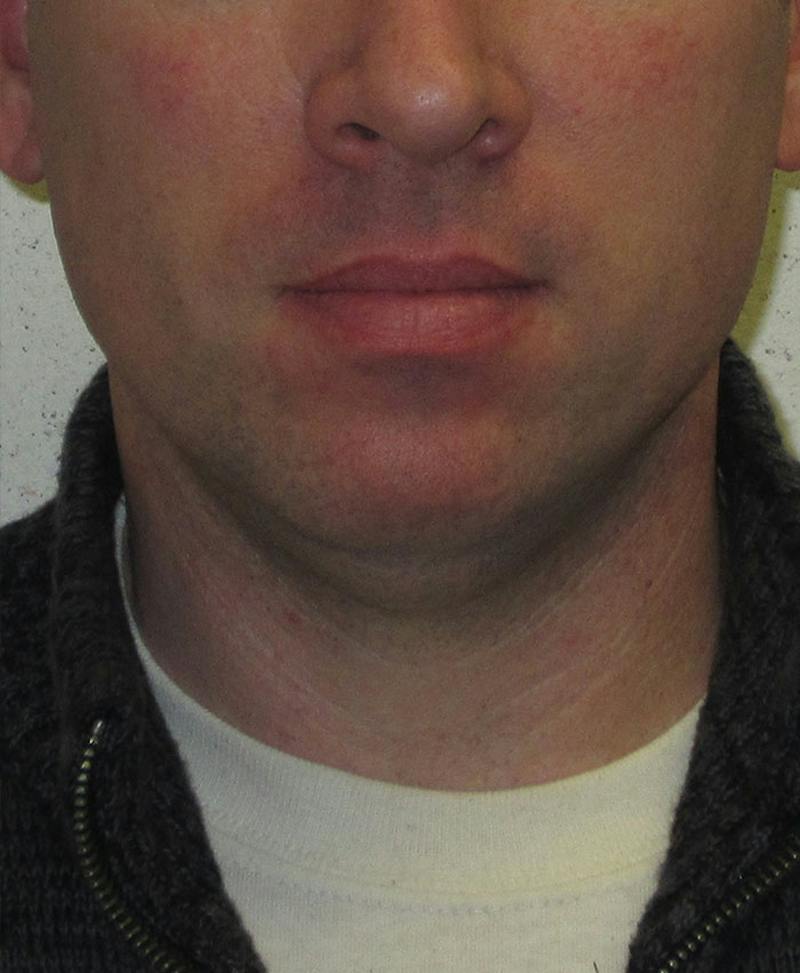 Male Plastic Surgery Before & After Gallery - Patient 302650 - Image 1