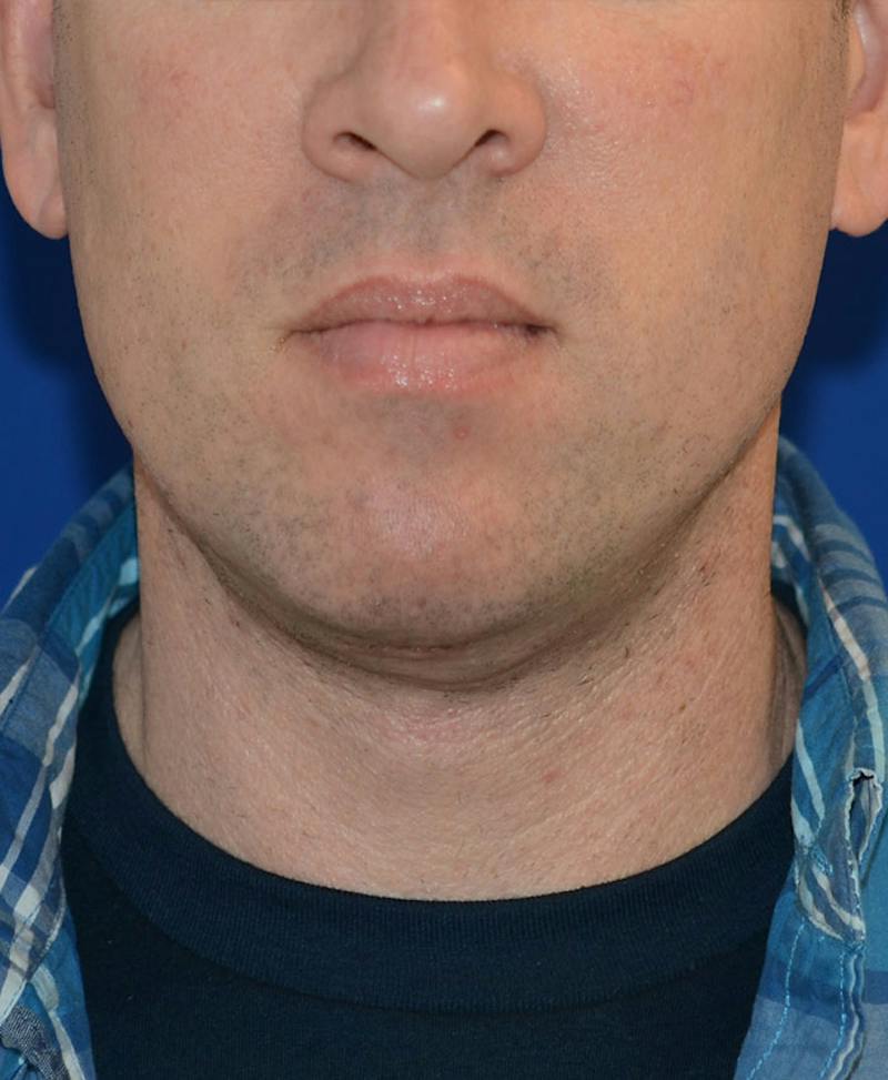 Male Plastic Surgery Before & After Gallery - Patient 302650 - Image 2