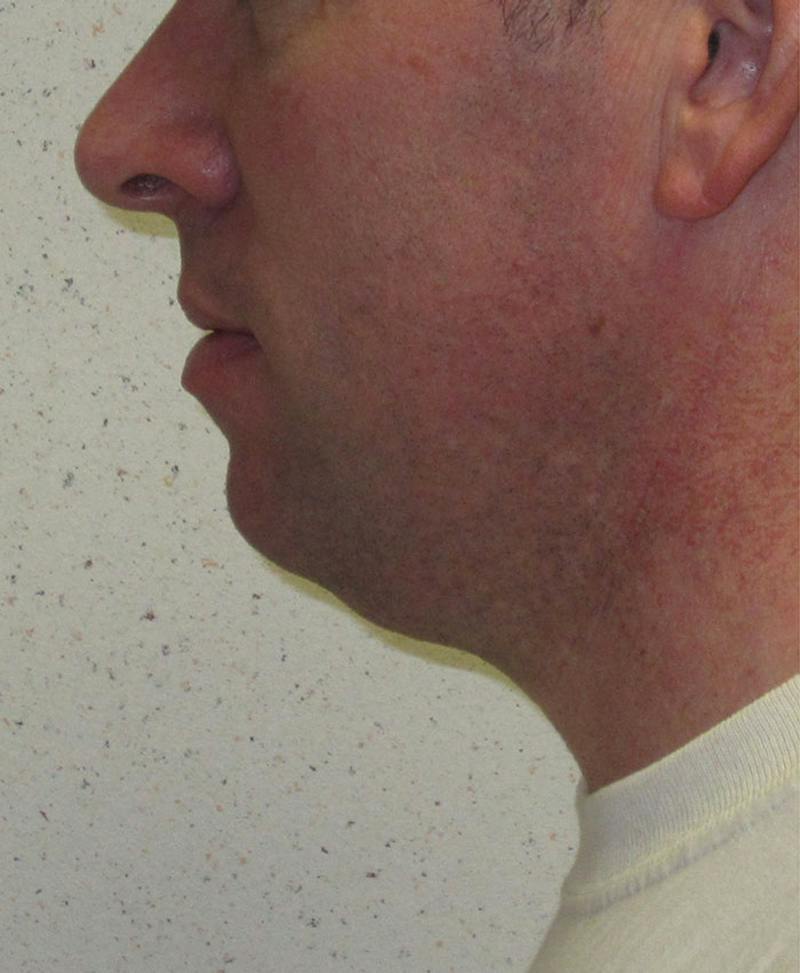Male Plastic Surgery Before & After Gallery - Patient 302650 - Image 3