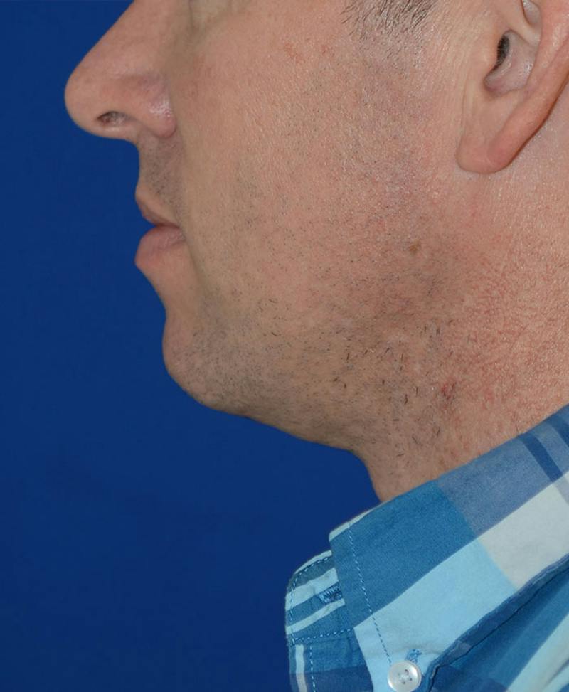 Male Plastic Surgery Before & After Gallery - Patient 302650 - Image 4