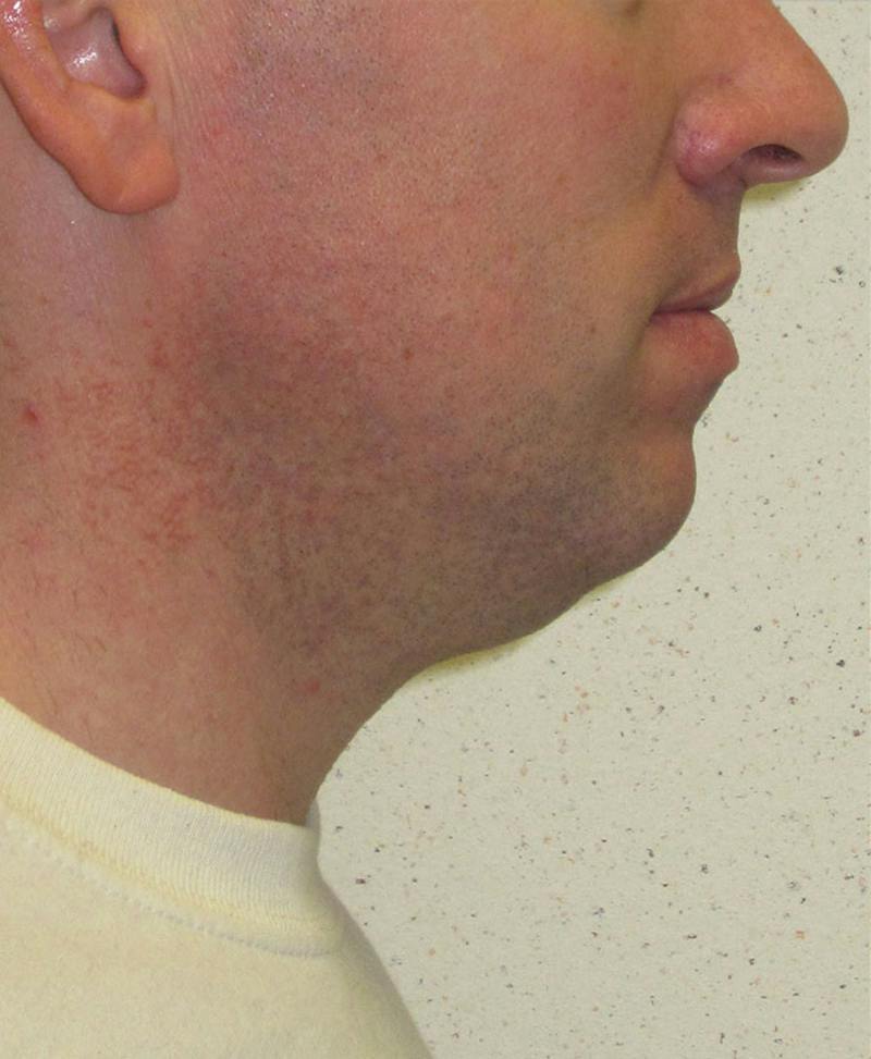 Male Plastic Surgery Before & After Gallery - Patient 302650 - Image 5