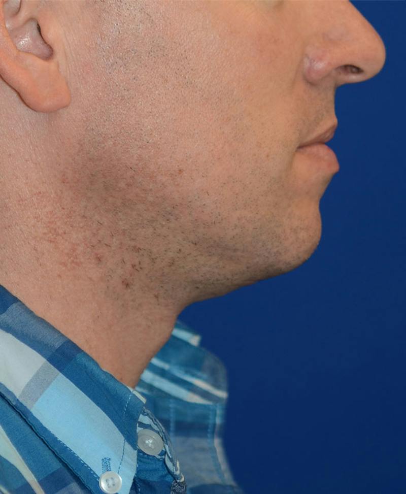 Male Plastic Surgery Before & After Gallery - Patient 302650 - Image 6