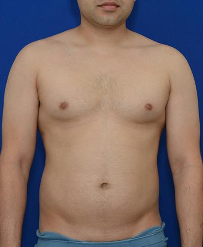 Liposuction Before & After Gallery - Patient 114206 - Image 1