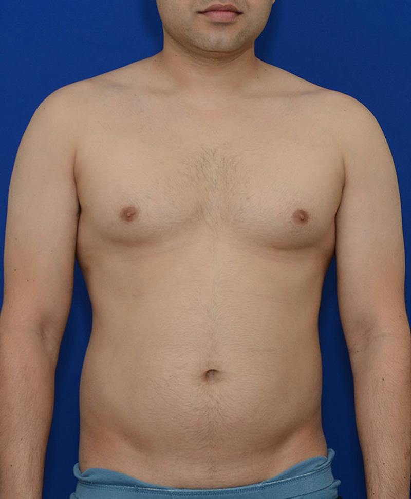 Male Plastic Surgery Before & After Gallery - Patient 255360 - Image 1