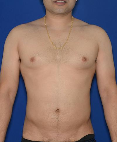 Liposuction Before & After Gallery - Patient 114206 - Image 2
