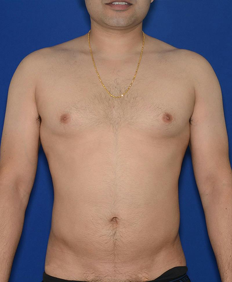 Male Plastic Surgery Before & After Gallery - Patient 255360 - Image 2