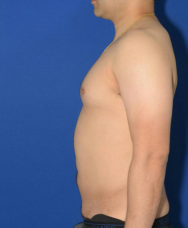 Male Plastic Surgery Before & After Gallery - Patient 255360 - Image 4