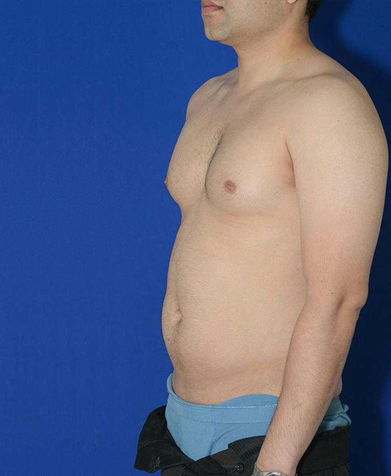 Male Plastic Surgery Before & After Gallery - Patient 255360 - Image 5