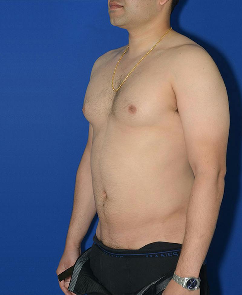 Male Plastic Surgery Before & After Gallery - Patient 255360 - Image 6