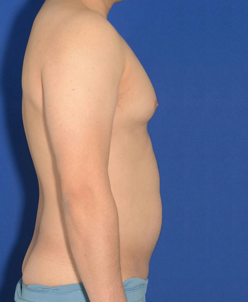 Male Plastic Surgery Before & After Gallery - Patient 255360 - Image 7