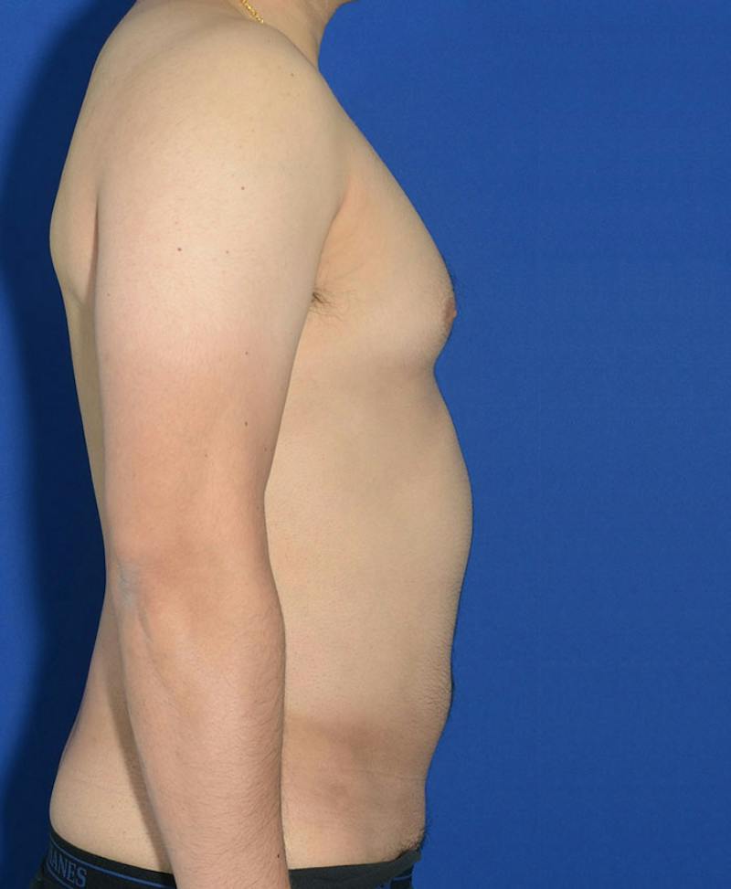 Male Plastic Surgery Before & After Gallery - Patient 255360 - Image 8
