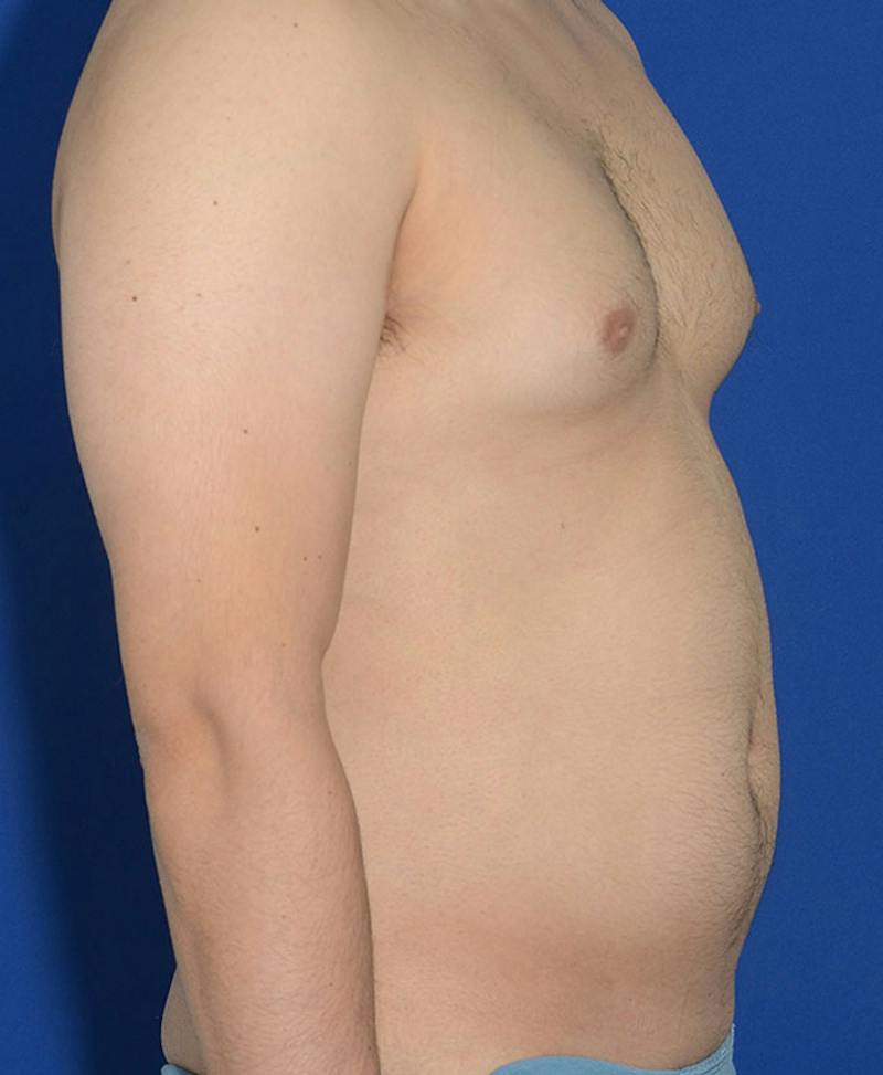 Male Plastic Surgery Before & After Gallery - Patient 255360 - Image 9