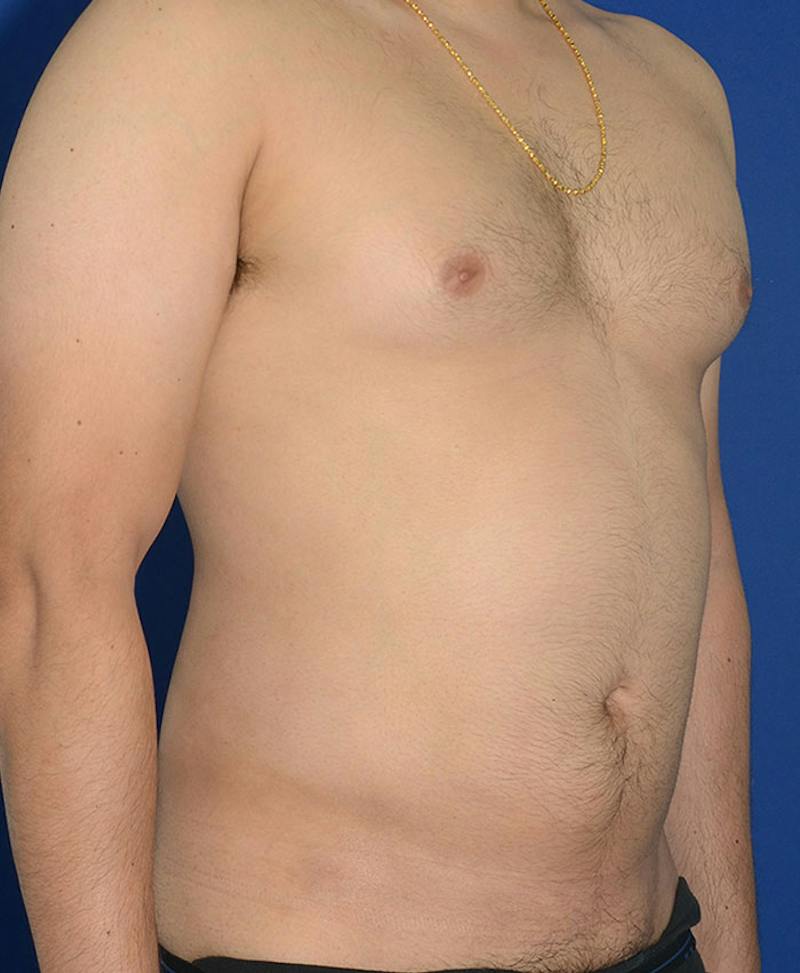 Male Plastic Surgery Before & After Gallery - Patient 255360 - Image 10