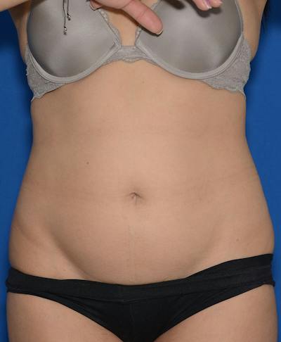 Liposuction Before & After Gallery - Patient 695050 - Image 1