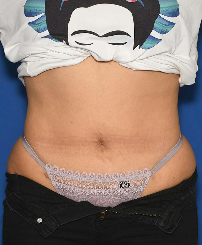 Liposuction Before & After Gallery - Patient 695050 - Image 2