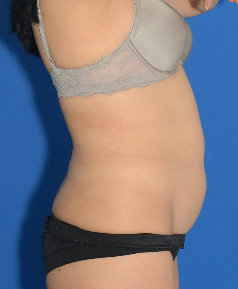 Liposuction Before & After Gallery - Patient 695050 - Image 9