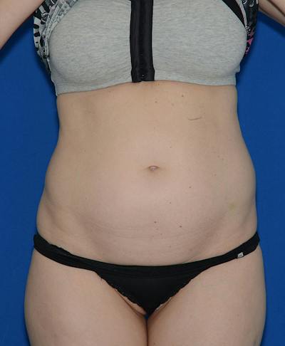 Liposuction Before & After Gallery - Patient 131998 - Image 1