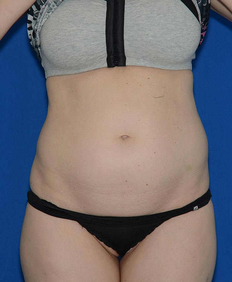 Liposuction Before & After Gallery - Patient 131998 - Image 1