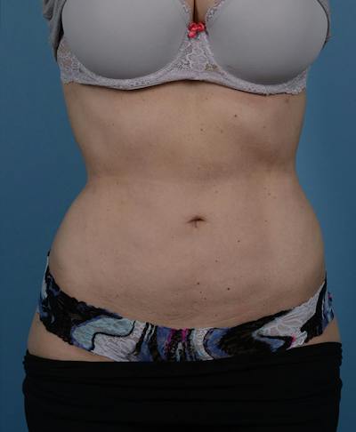 Liposuction Before & After Gallery - Patient 131998 - Image 2