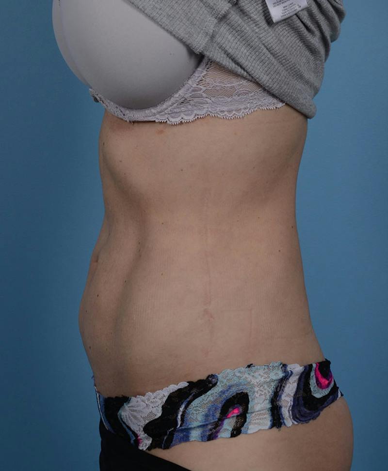 Liposuction Before & After Gallery - Patient 131998 - Image 6