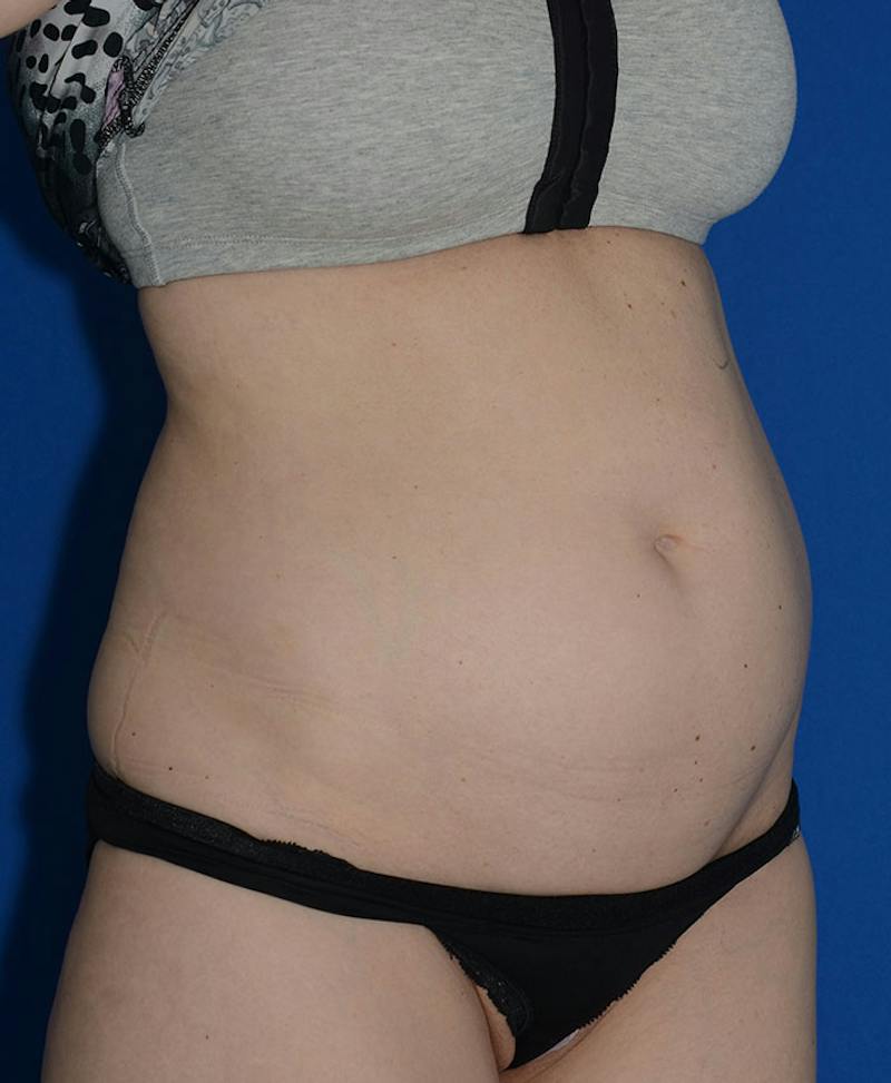 Liposuction Before & After Gallery - Patient 131998 - Image 7