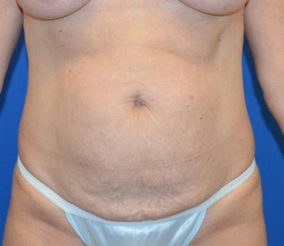 Tummy Tuck Before & After Gallery - Patient 586927 - Image 1