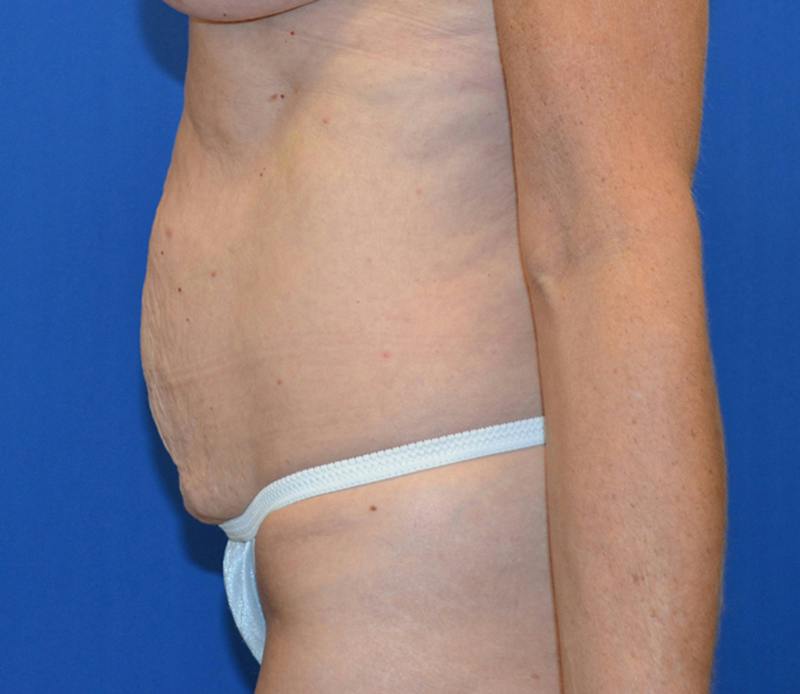 Tummy Tuck Before & After Gallery - Patient 586927 - Image 3
